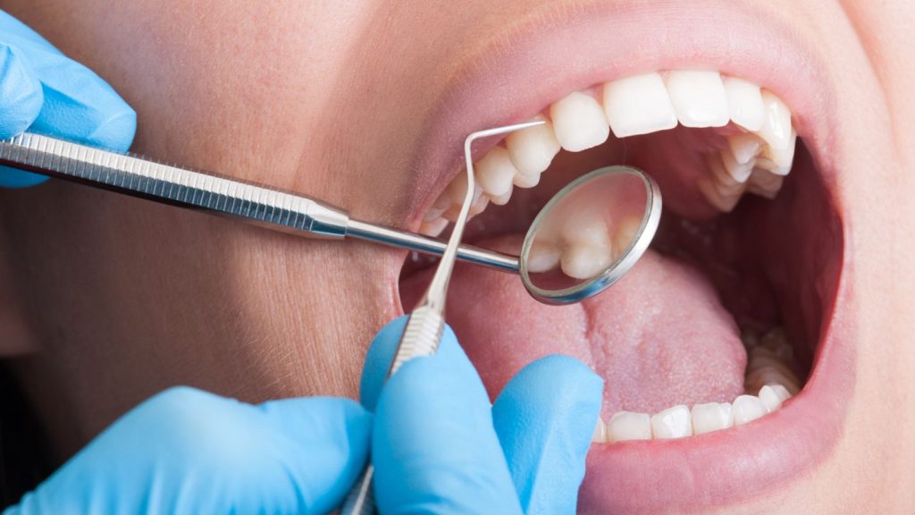 A dental cleaning session in progress, showing a person having their teeth cleaned with a dental instrument.