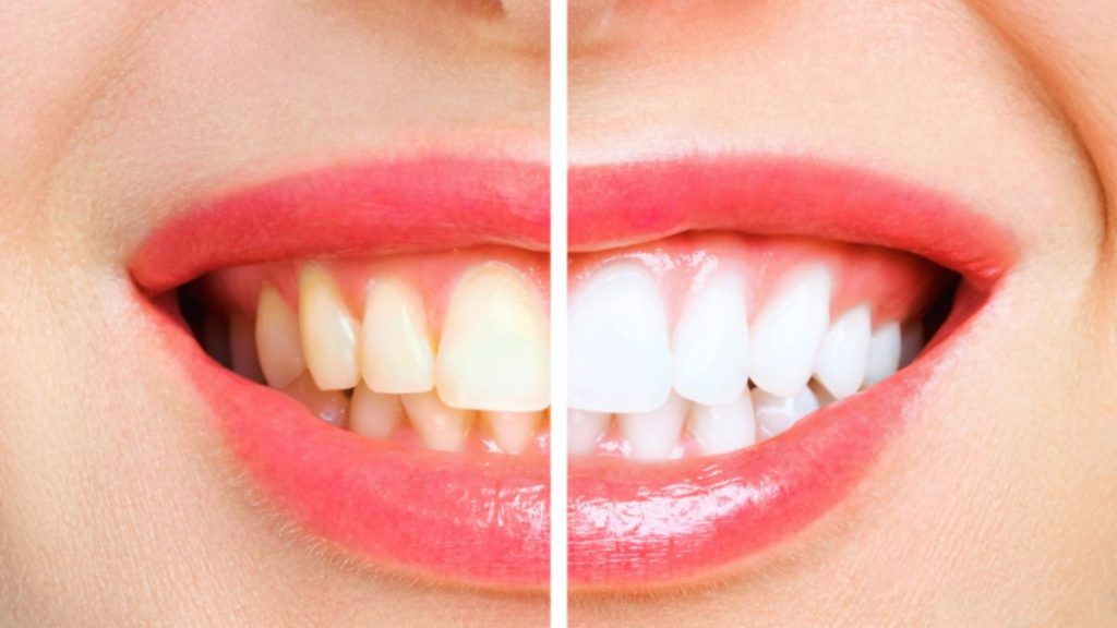 A woman with a radiant smile displaying her teeth before and after her teeth whitening procedure.