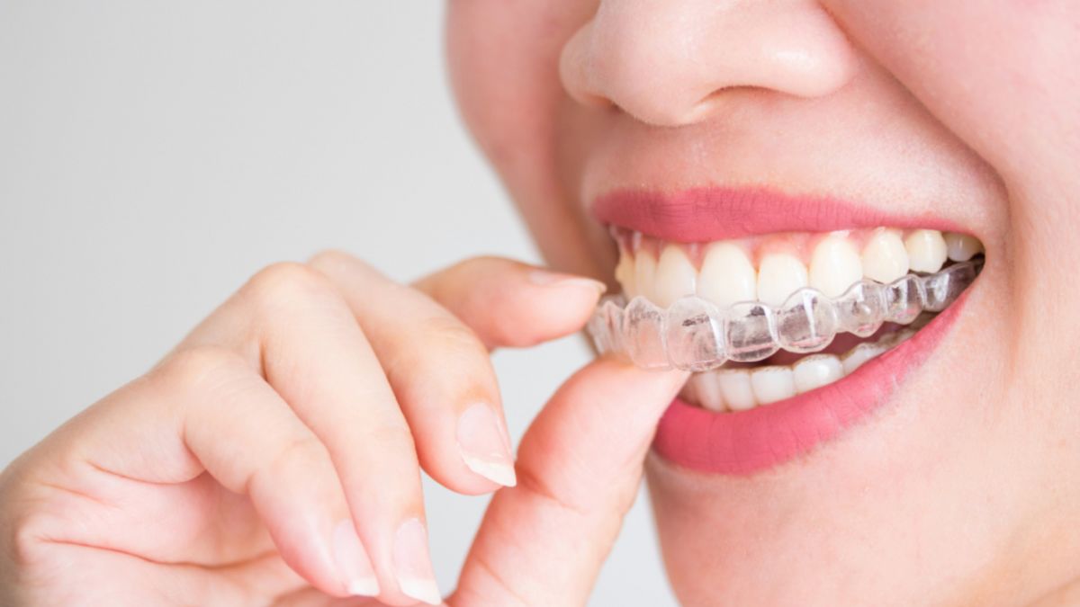 A woman with clear Invisalign braces, smiling confidently to display her teeth.