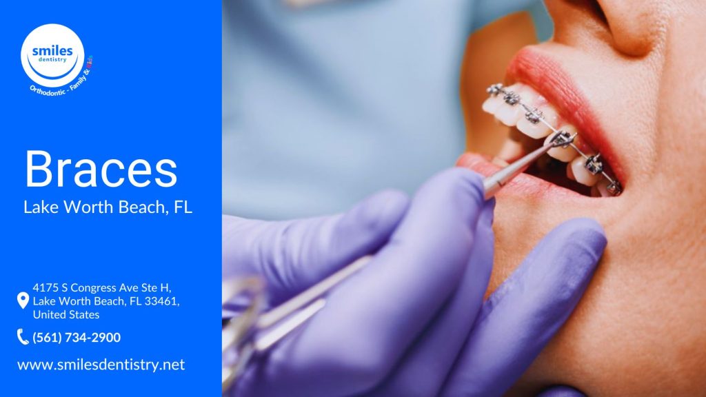 Braces are orthodontic devices that gradually align the jaw and straighten teeth using brackets, wires, and elastic bands. They help correct overcrowding, gaps, overbites, underbites, and crooked teeth, improving both function and appearance. Proper alignment enhances oral health, reduces the risk of cavities and gum disease, and promotes better hygiene, leading to a healthier, more confident smile.