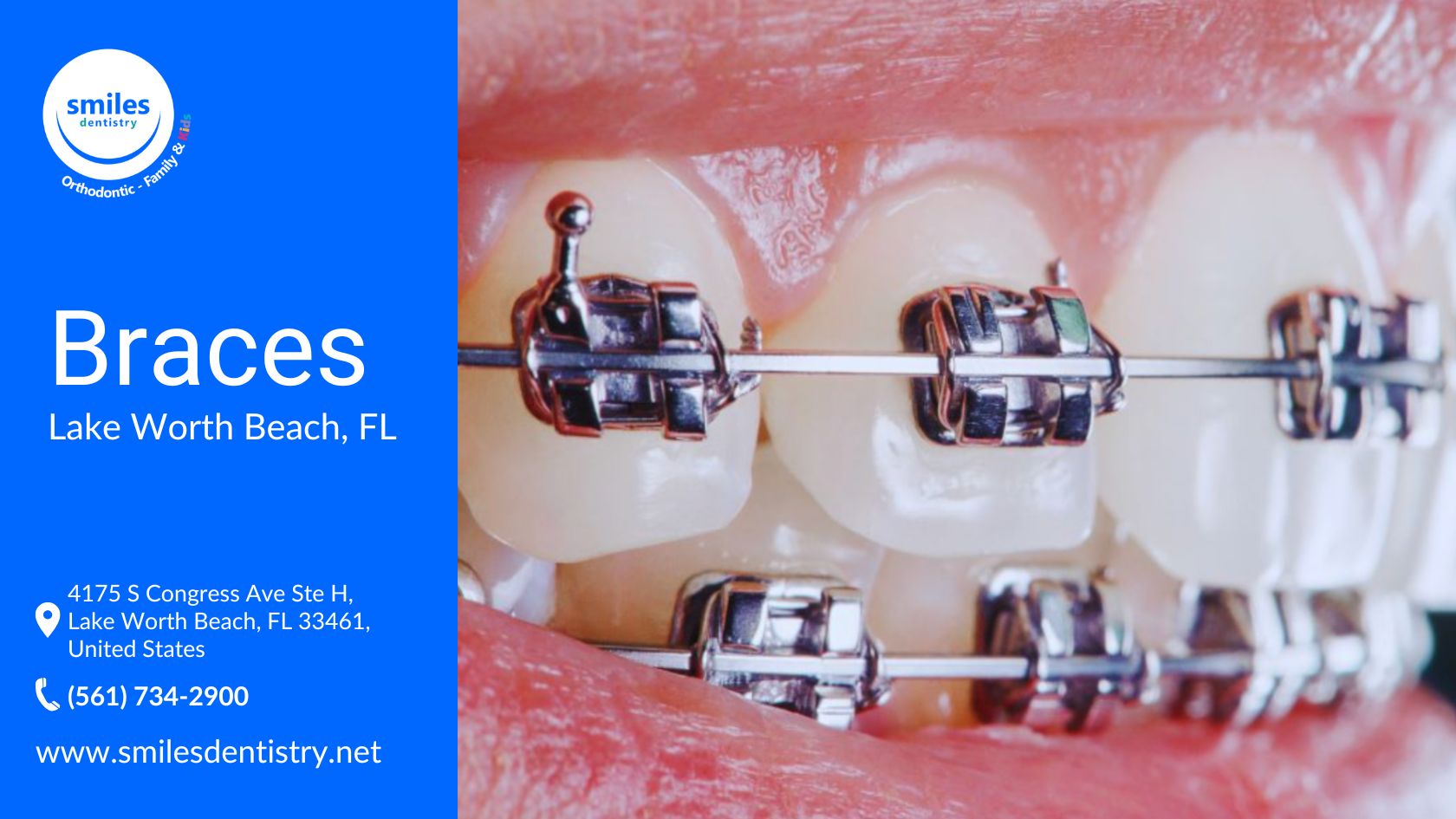 A close-up of a patient's teeth fitted with self-ligating metal braces featuring built-in clips for secure placement.