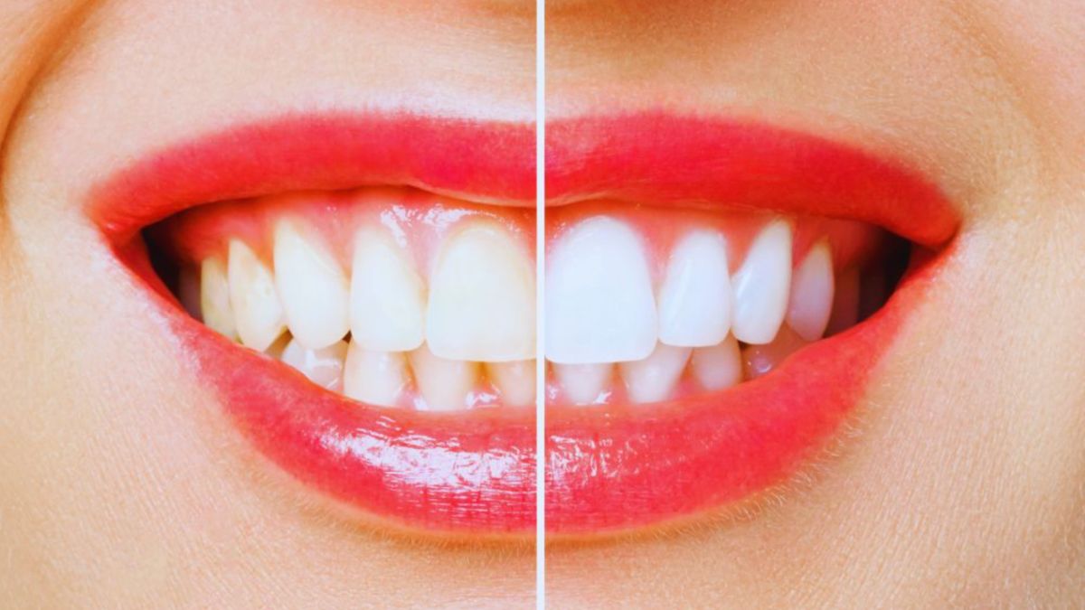 A woman with bright, white teeth smiling confidently after a teeth whitening procedure.