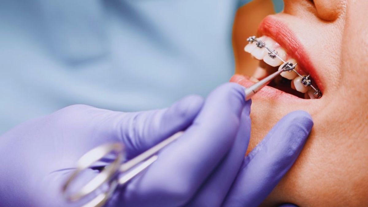 A close-up photograph showing an orthodontist adjusting metal braces on a patient’s teeth, representing orthodontic care.
