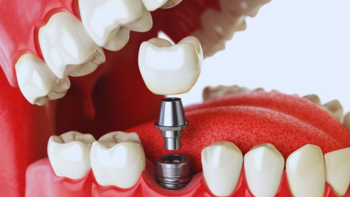 Close-up 3D image showing a dental crown placed on an implant abutment surrounded by natural teeth and gums in Lake Worth.