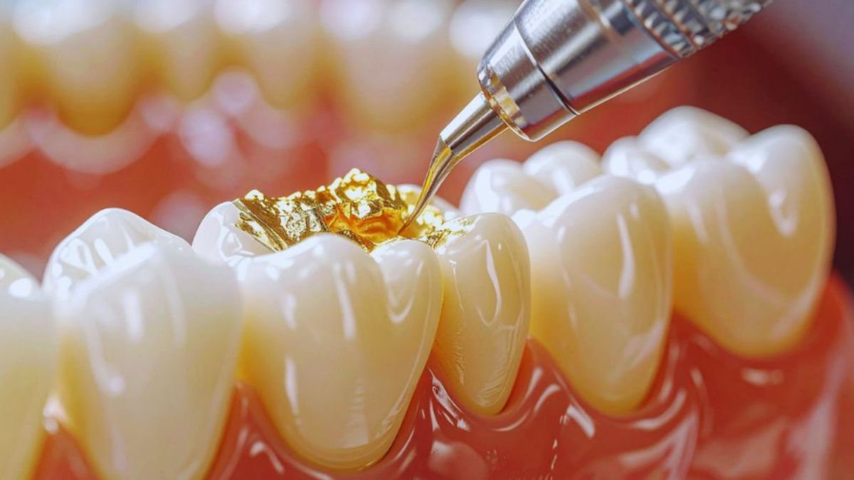 A close-up view of dental restorative treatment showing a gold filling being placed in a molar tooth, with dental equipment and realistic gum tissue visible.