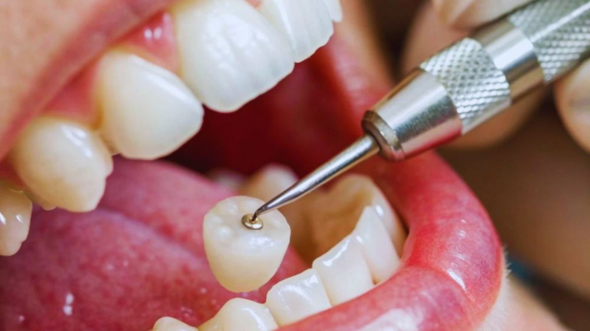 A close-up view shows a dental tool working on a crown placed on a lower tooth inside an open mouth, highlighting the precision of dental crown procedures.